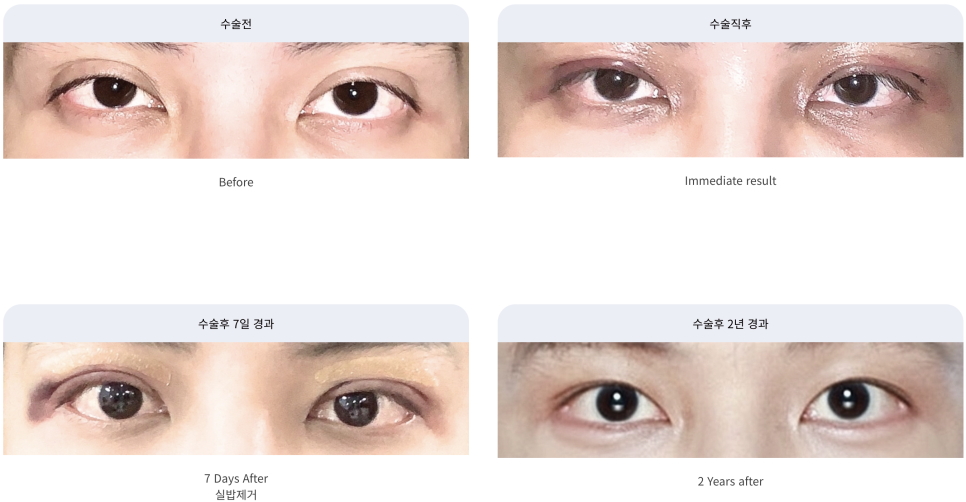 남자 눈성형 두꺼운 쌍꺼풀 풀기 관련 이미지 10