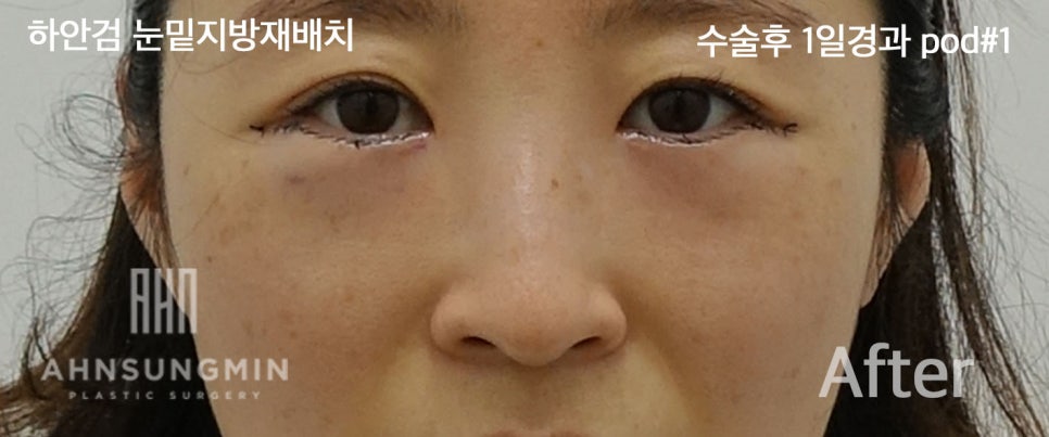 [안성민 성형외과]하안검지방재배치 고객님입니다^^ 관련 이미지 3