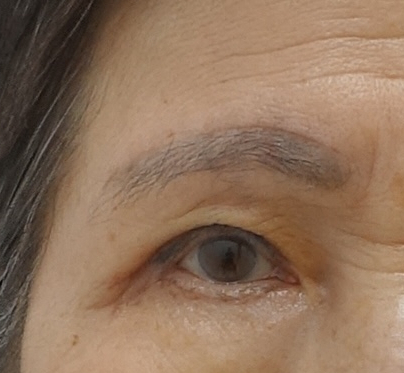 꺼진 눈 나이 들어 보이는 이유, 꺼진 눈 해결 방법 관련 이미지 4