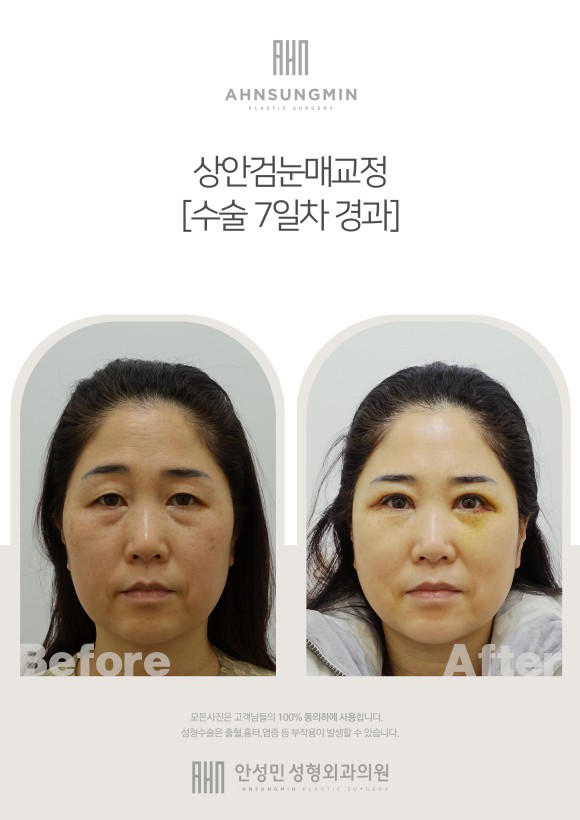 [잠실동성형외과] 상안검눈매교정 7일차경과 / 나에게 맞는 눈라인을 찾았다 ​ 관련 이미지 2