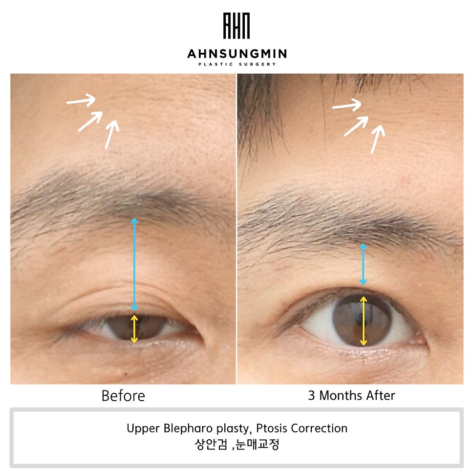 남자 안검하수, 눈이 커지고 싶어요 관련 이미지 4