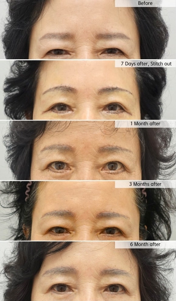 눈썹상거상 수술 후 흉터 회복 과정 관련 이미지 1
