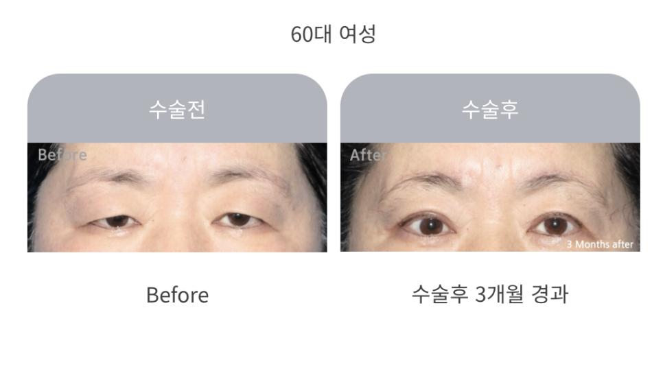 중년 상안검 수술의 특징과 주의사항 관련 이미지 4