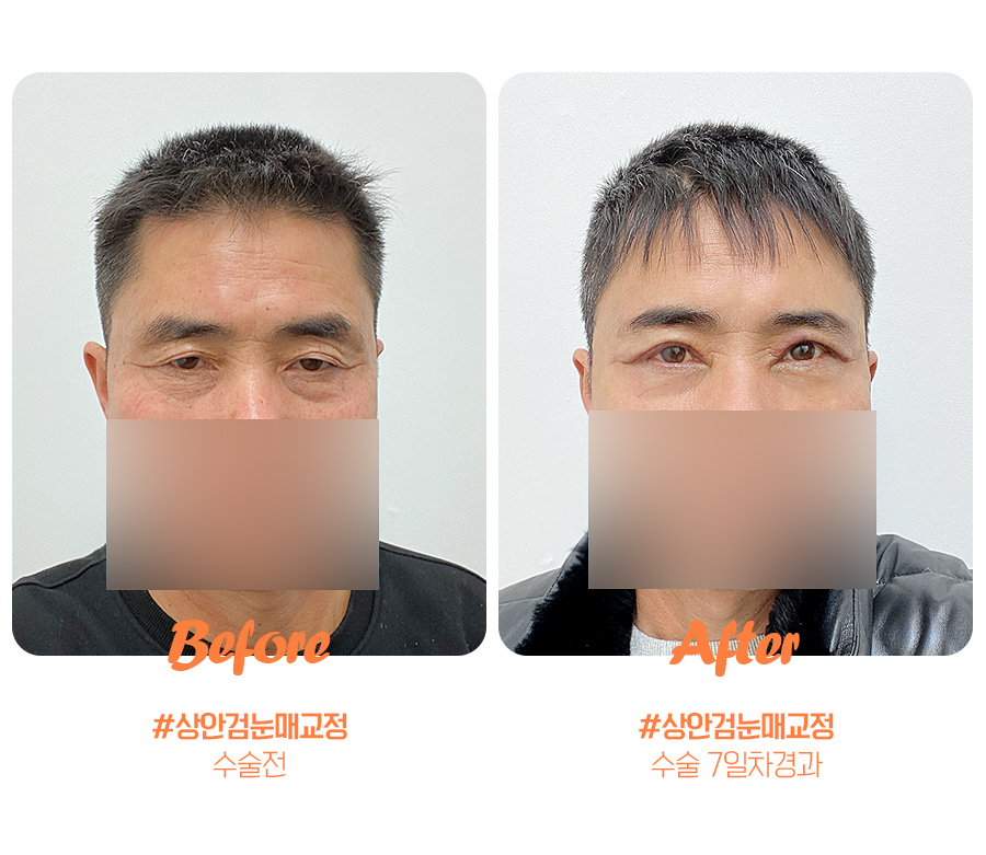 [잠실동성형외과] 다시 찾은 나의 외모자신감! 어려보이는 인상으로 변신! / 잠실성형외과 관련 이미지 2