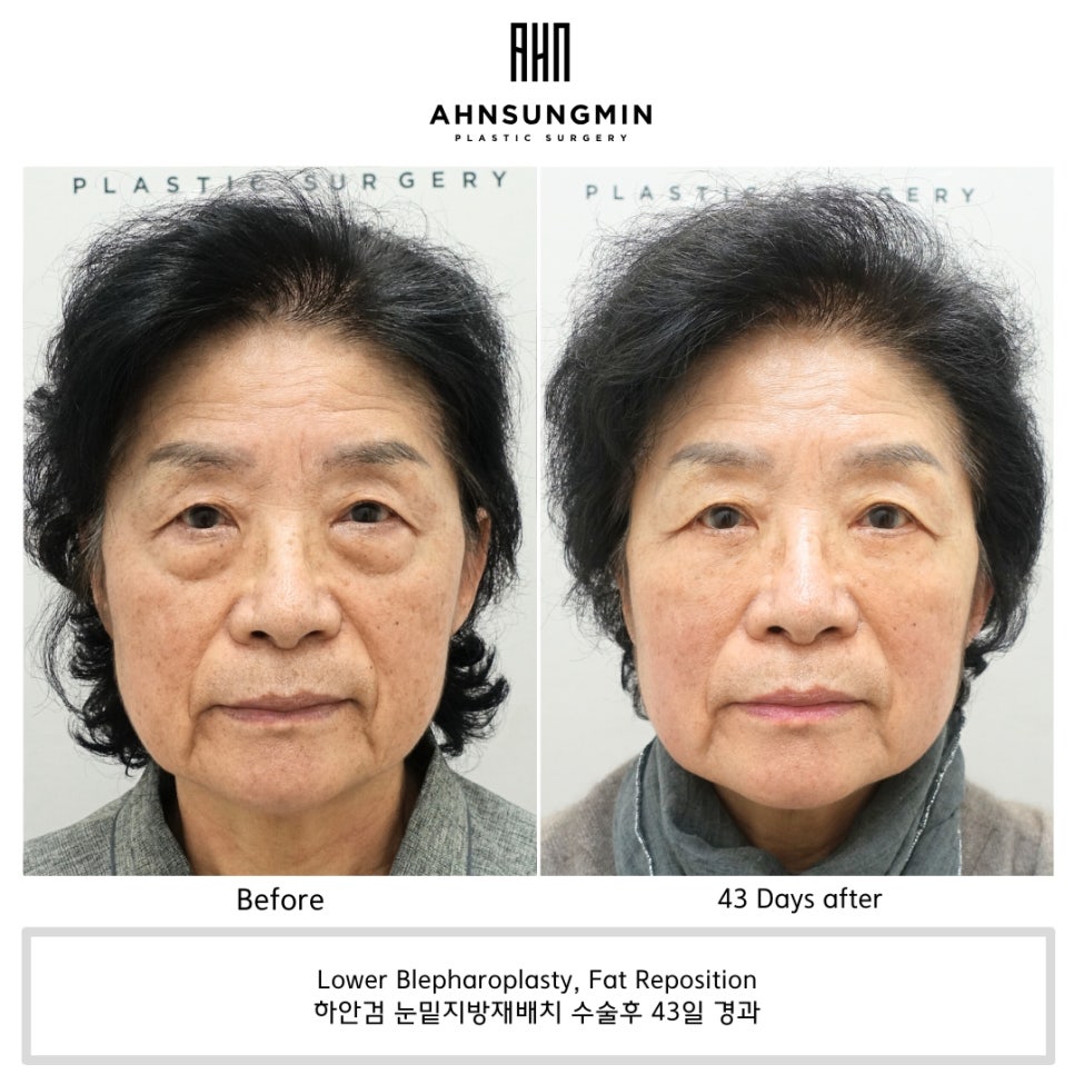 나이대별 눈밑지방재배치 수술 전후 사진 비교 관련 이미지 7