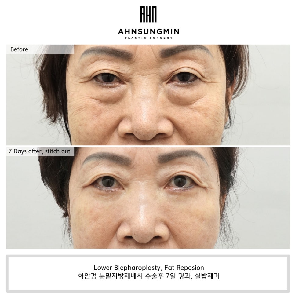 70대 여성 하안검 노화 과정에 따른 하안검 수술 주의점 관련 이미지 2
