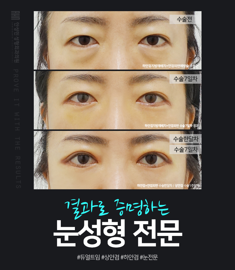 [잠실동성형외과] 결과로 증명하는 눈성형 전문 잠실성형외과 / 하안검지방재배치 / 상안검(쌍꺼풀) 수술후기 / 수술리뷰 관련 이미지 1
