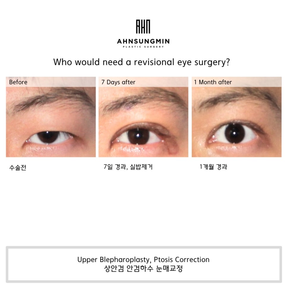 안검하수의 원인과 눈매교정 수술 전후 관련 이미지 1