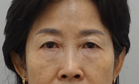 [하안검 재수술의 진실] 하안검도 재수술이 가능할까? 관련 이미지 5