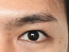 [재수술] 남자 쌍꺼풀이 두꺼워 보이는 원인은 안검하수 관련 이미지 4