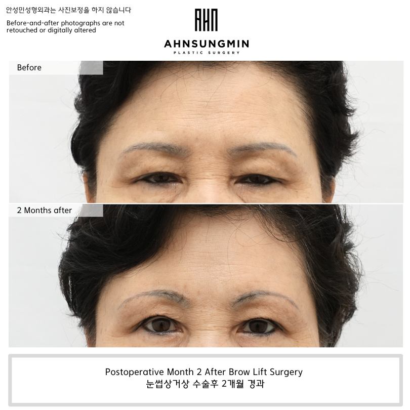 Why Did My Eyes Look More Relaxed After a Brow Lift? | Forehead Compensation and Changes in Heavy-Looking Eyes image 1