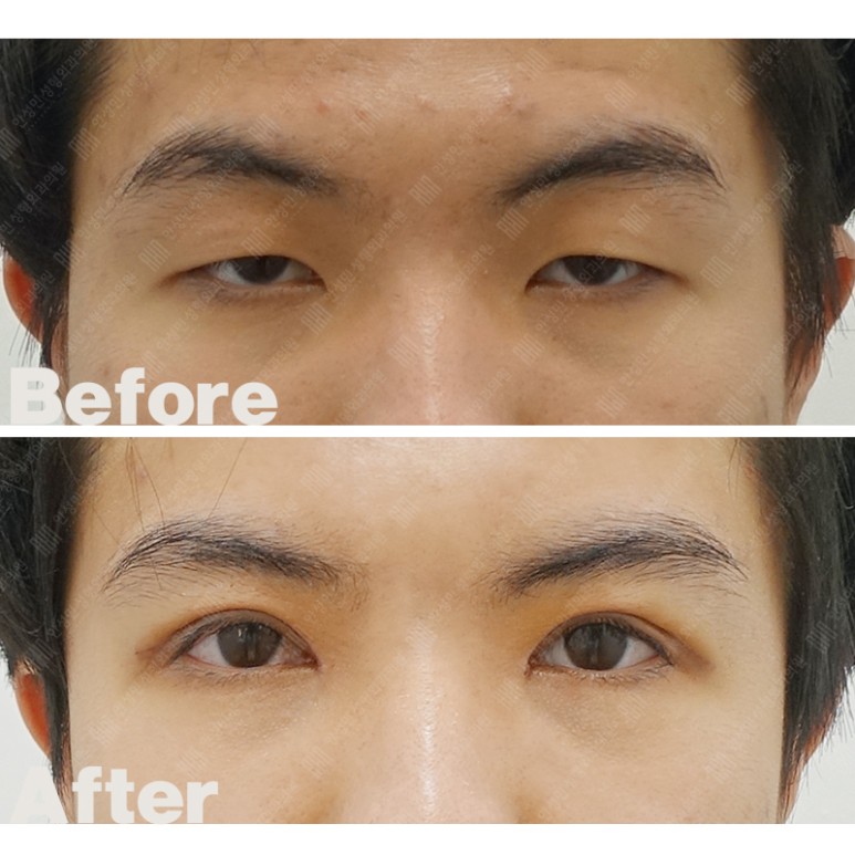 상안검 눈매교정 관련 이미지 3