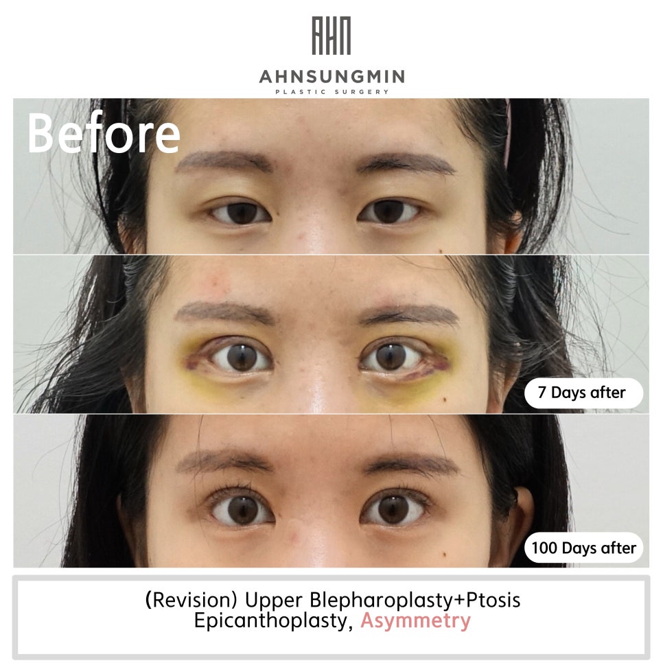 매몰 쌍꺼풀 후 재수술 절개쌍꺼풀 회복과정[안성민성형외과] 관련 이미지 5