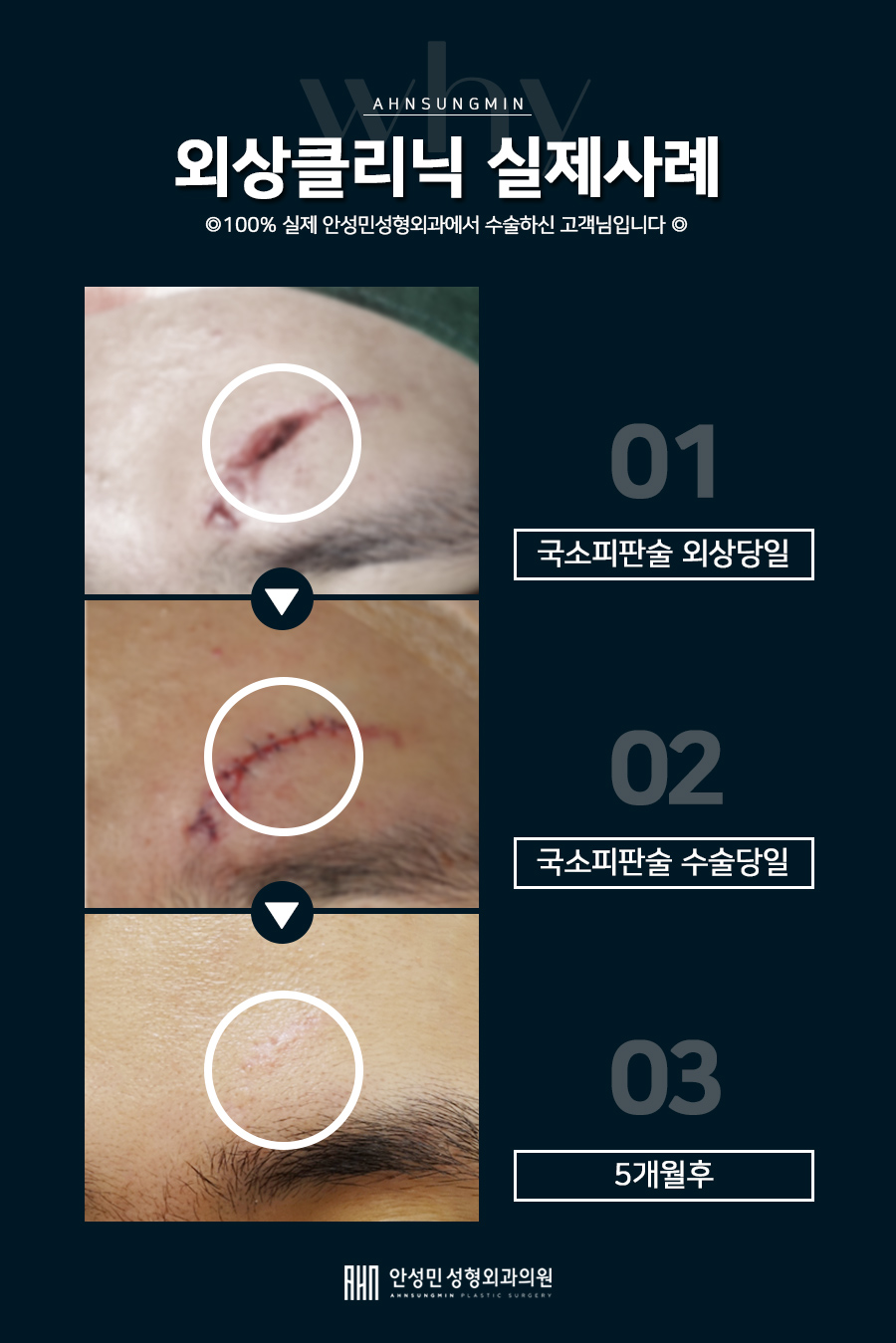 [잠실동성형외과] 급하게 꼬매야 한다면? 소중한 아이가 다쳤다면? 일단, 잠실 안성민성형외과! 외상사진포함[주의] 관련 이미지 3