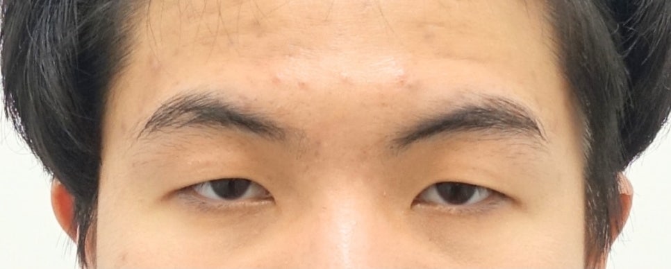 나이대별 상안검 수술 전후, 성형외과전문의 안성민 관련 이미지 3