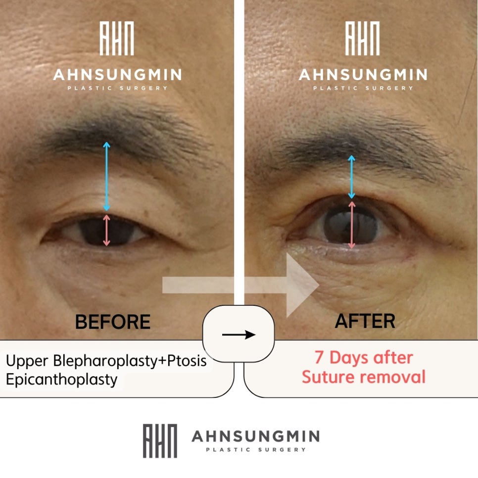 중년남성 진성안검하수 눈매교정 상안검성형[성형외과전문의] 관련 이미지 3