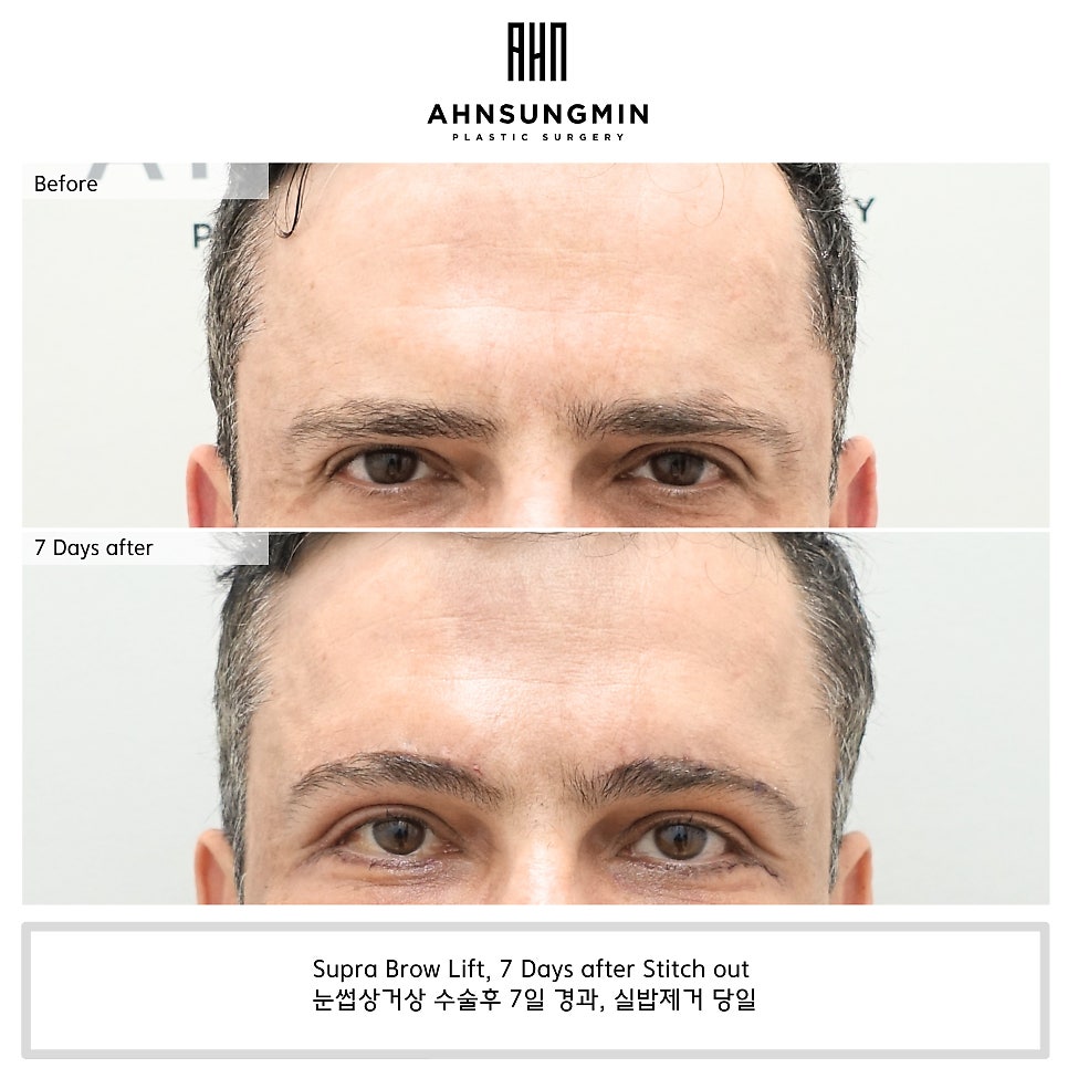 남자도 눈썹 거상 수술을 할 수 있을까요? 관련 이미지 2