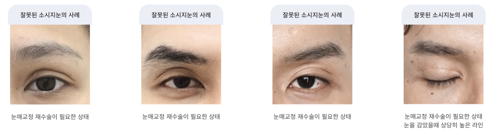 남자 눈성형 두꺼운 쌍꺼풀 풀기 관련 이미지 5