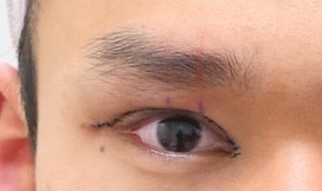 남자 눈성형 두꺼운 쌍꺼풀 풀기 관련 이미지 3