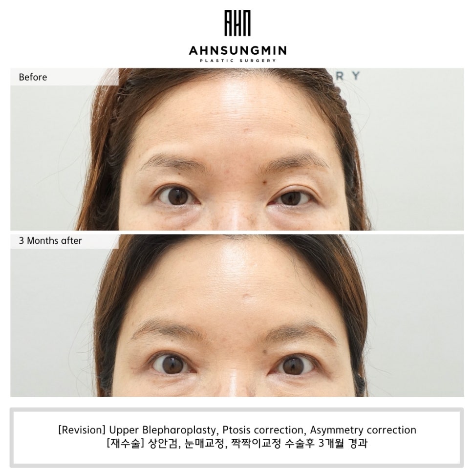 짝짝이 눈 한쪽만 교정할 수 있을까? 관련 이미지 1