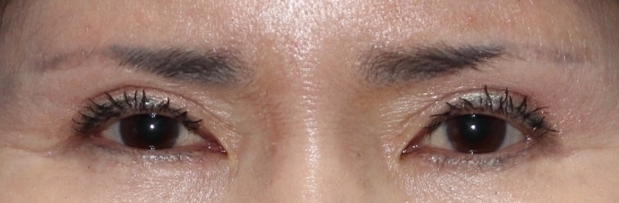 눈썹하거상 수술의 부작용과 눈썹상거상 수술이 필요한이유 관련 이미지 2