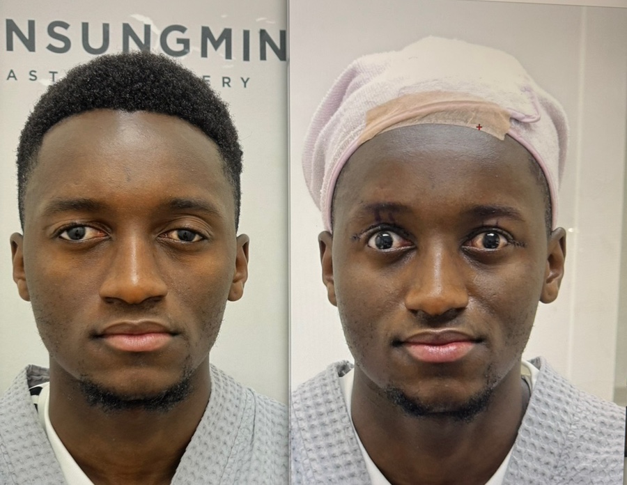 선천성 안검하수 짝짝이 눈매교정 재건수술[성형외과 전문의 안성민] 관련 이미지 5