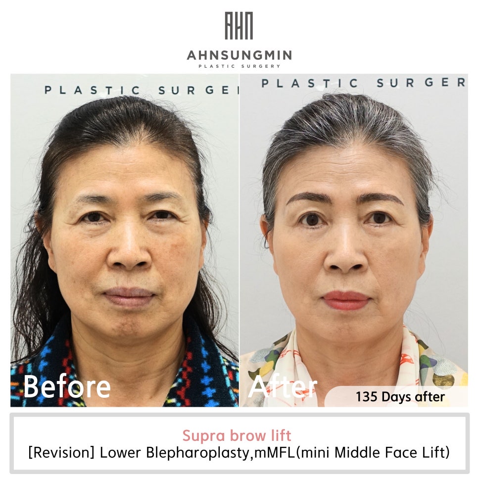 눈썹상거상후 눈썹문신(반영구문신) 가능한 시기 관련 이미지 2