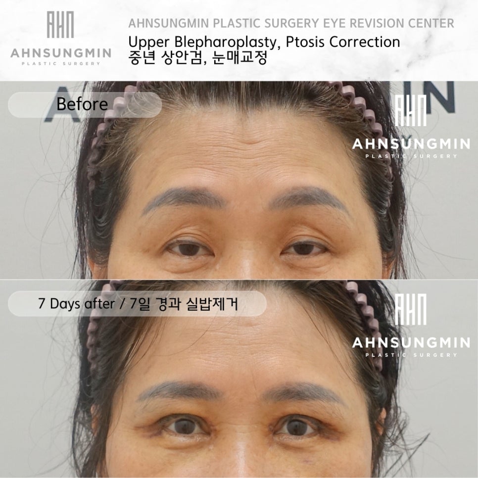 상안검 수술 잘하려면 [성형외과 전문의 안성민] 관련 이미지 2