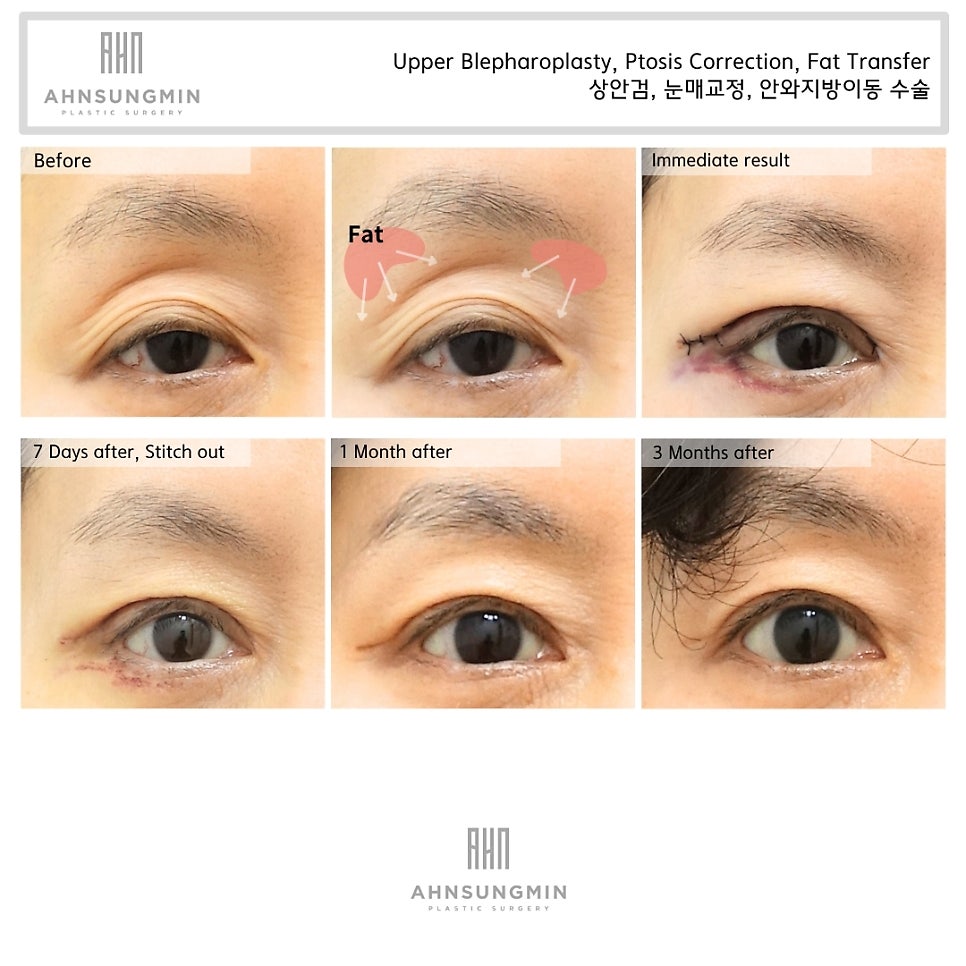 눈꺼풀 꺼짐의 원인과 해결 방법 관련 이미지 2