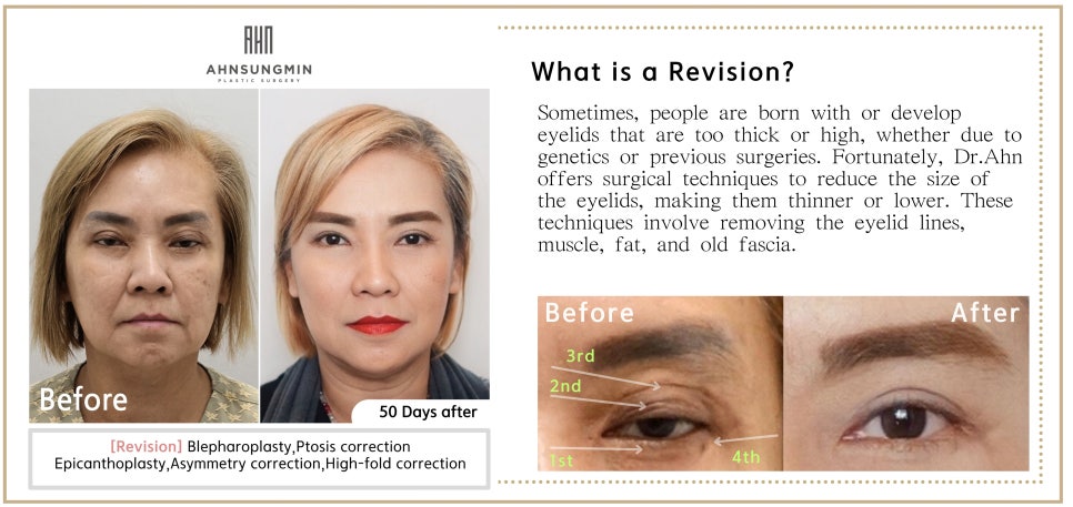 매몰 쌍꺼풀 후 재수술 절개쌍꺼풀 회복과정[안성민성형외과] 관련 이미지 3