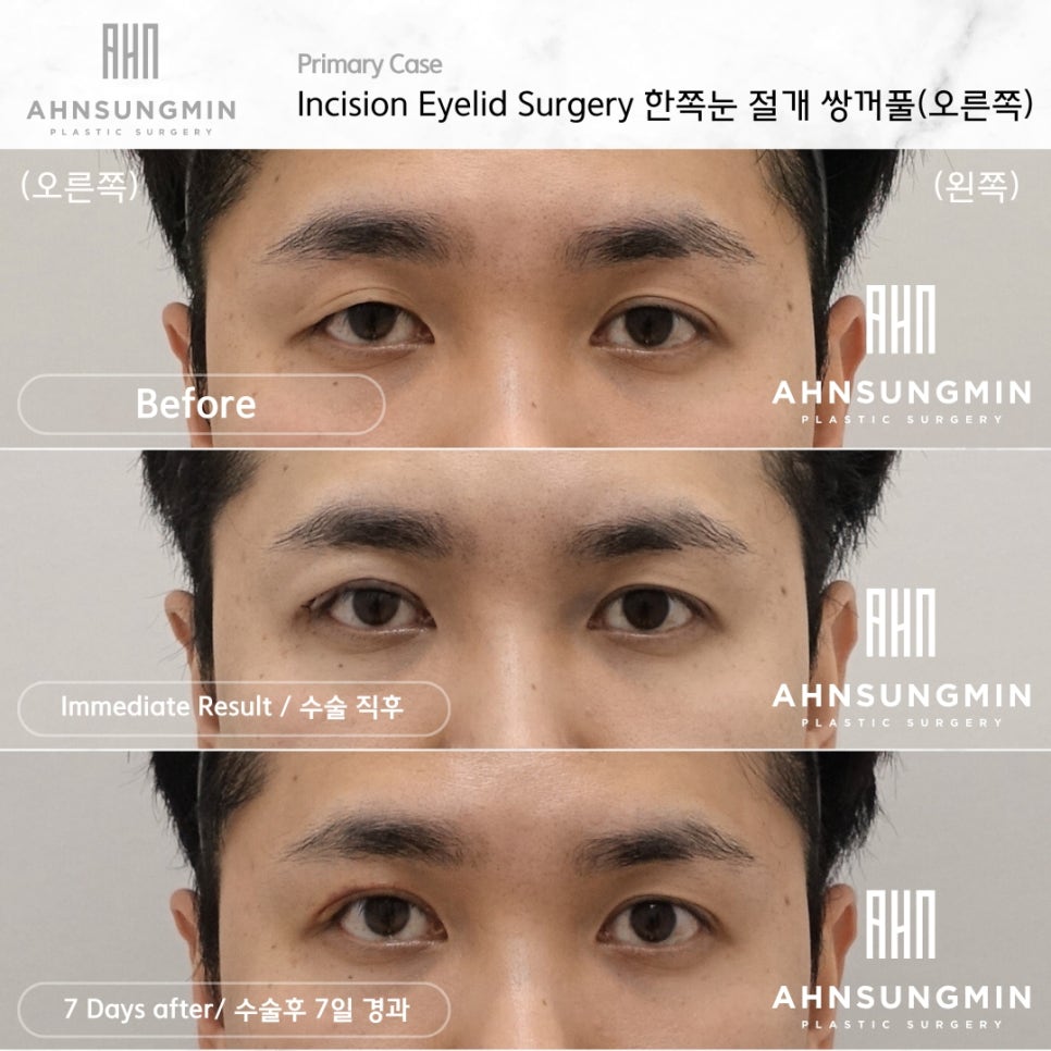 남자 돌출 눈 짝짝이 교정 잘하는 곳, 안검하수 짝짝이 안성민성형외과 관련 이미지 3