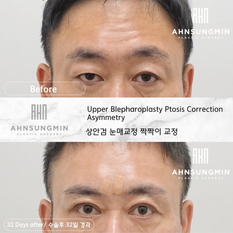남자 짝짝이 쌍꺼풀 교정 후 32일 경과 [성형외과 전문의 안성민] 관련 이미지 6