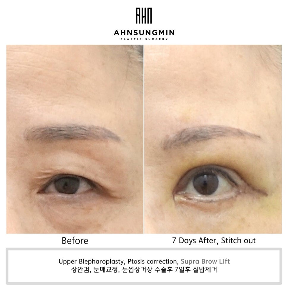 눈꺼풀 처짐의 원인과 눈썹 거상 수술이 필요한 이유 [성형외과 전문의 안성민] 관련 이미지 7