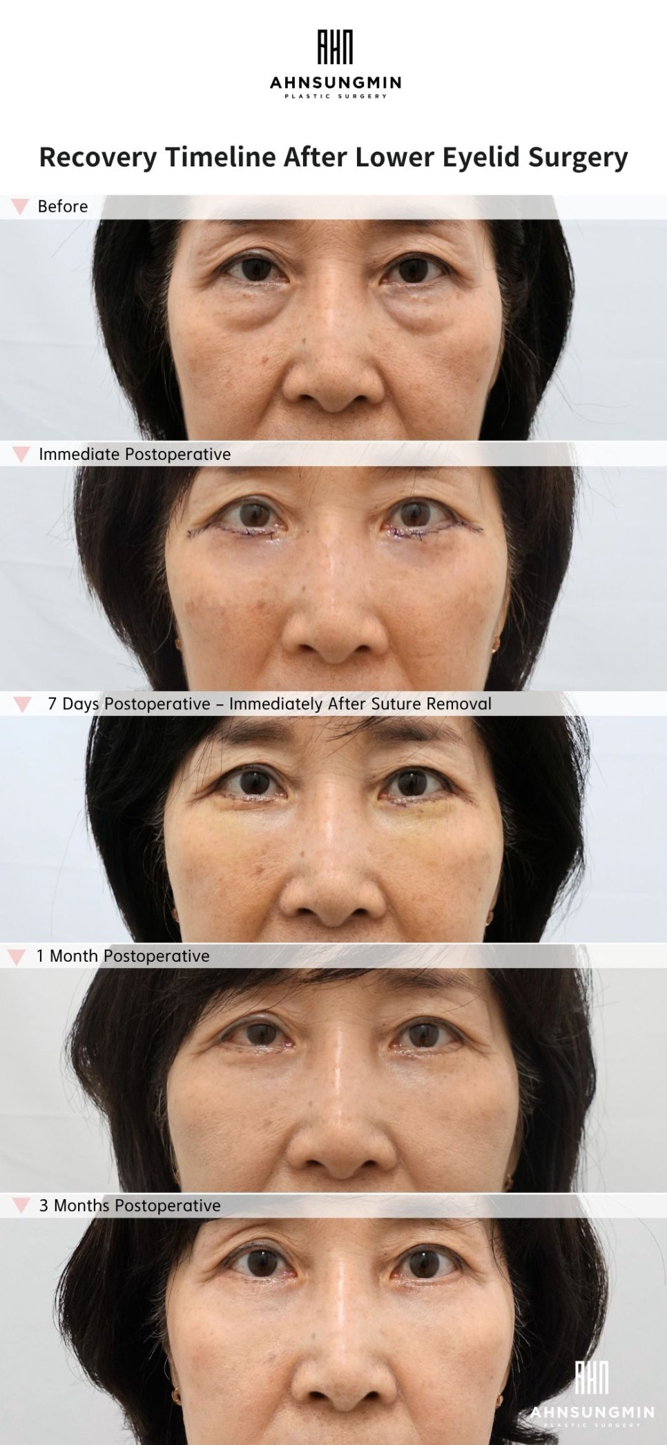 Lower Eyelid Surgery Recovery Process: How Natural Does It Actually Become? image 3
