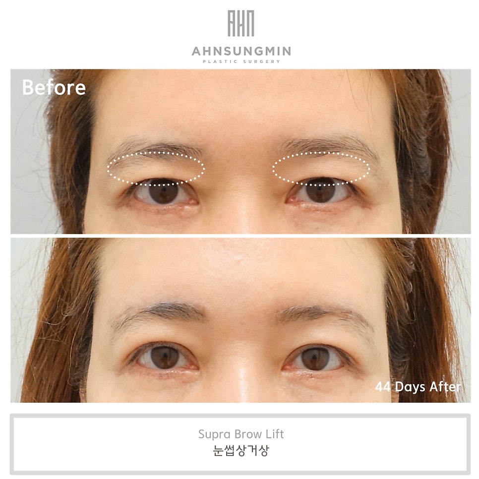 눈썹 거상 수술 흉터와 회복 과정 관련 이미지 6
