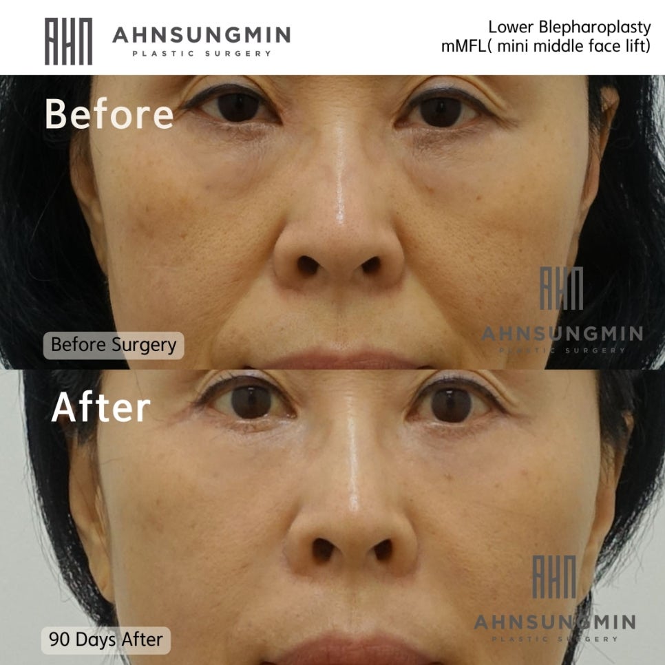 눈밑지방재배치 재수술 관련 이미지 2