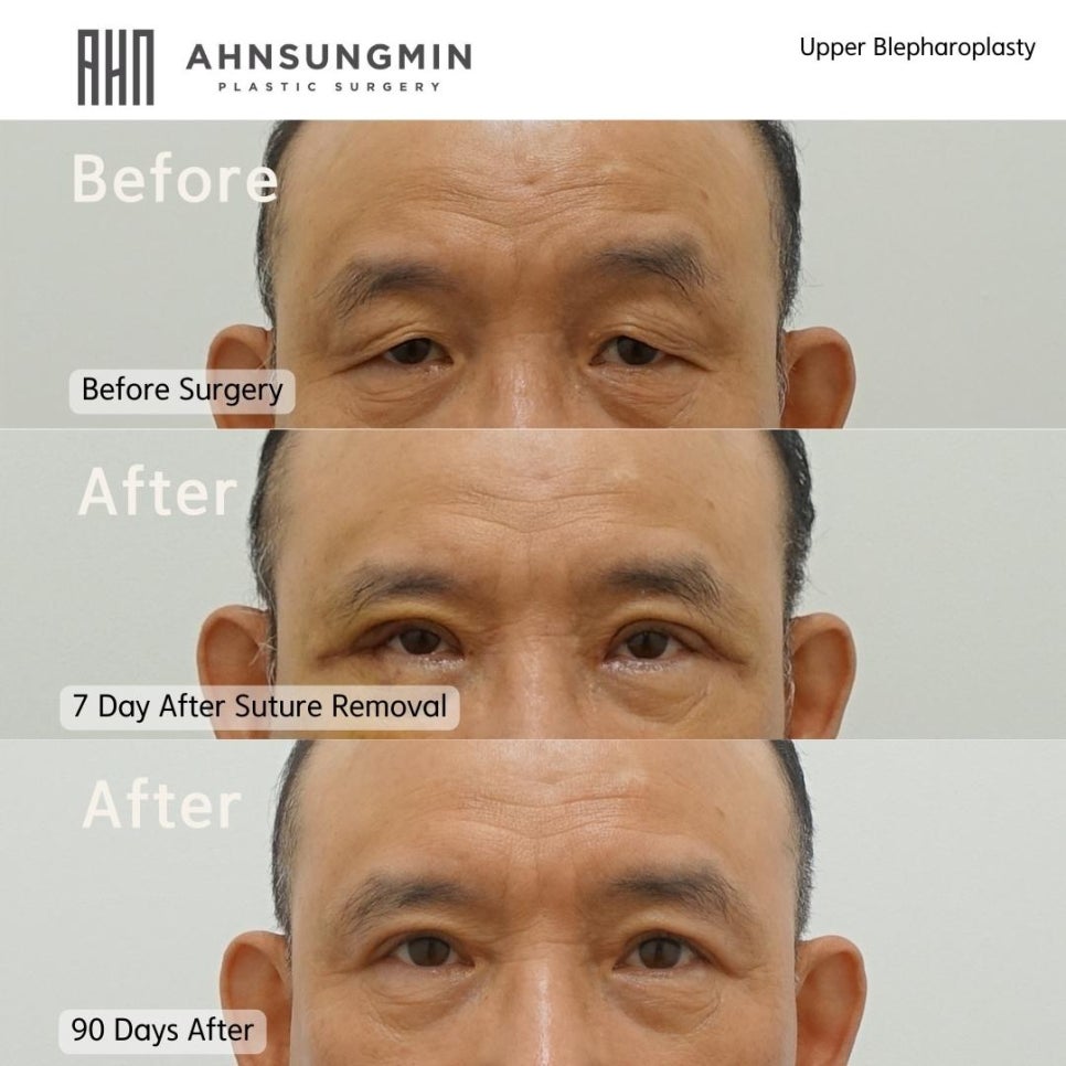 중년남성의 상안검 수술 회복기간은 어떻게 될까요? 관련 이미지 2