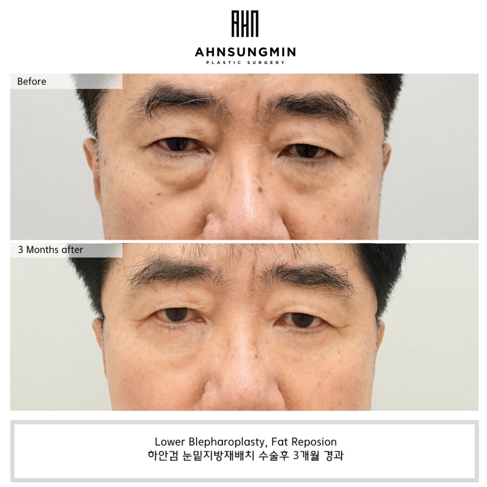 하안검 수술과 혈압관리, 아스피린을 끈어야 하는 이유 관련 이미지 1