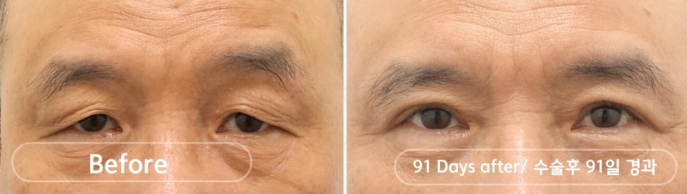 나이대별 상안검 수술, 처진 눈꺼풀을 개선하다 관련 이미지 6