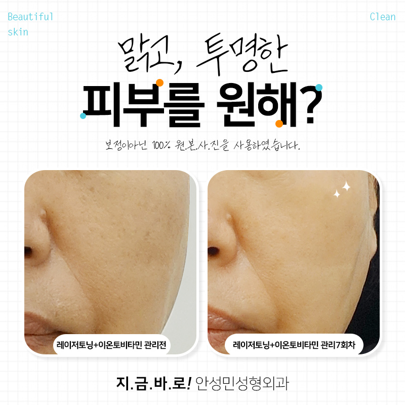 [잠실동성형외과] 칙칙하고 어두웠던 피.부.안.녕! 레이저토닝과 이온토비타민관리로 기미 / 잠실성형외과 관련 이미지 1