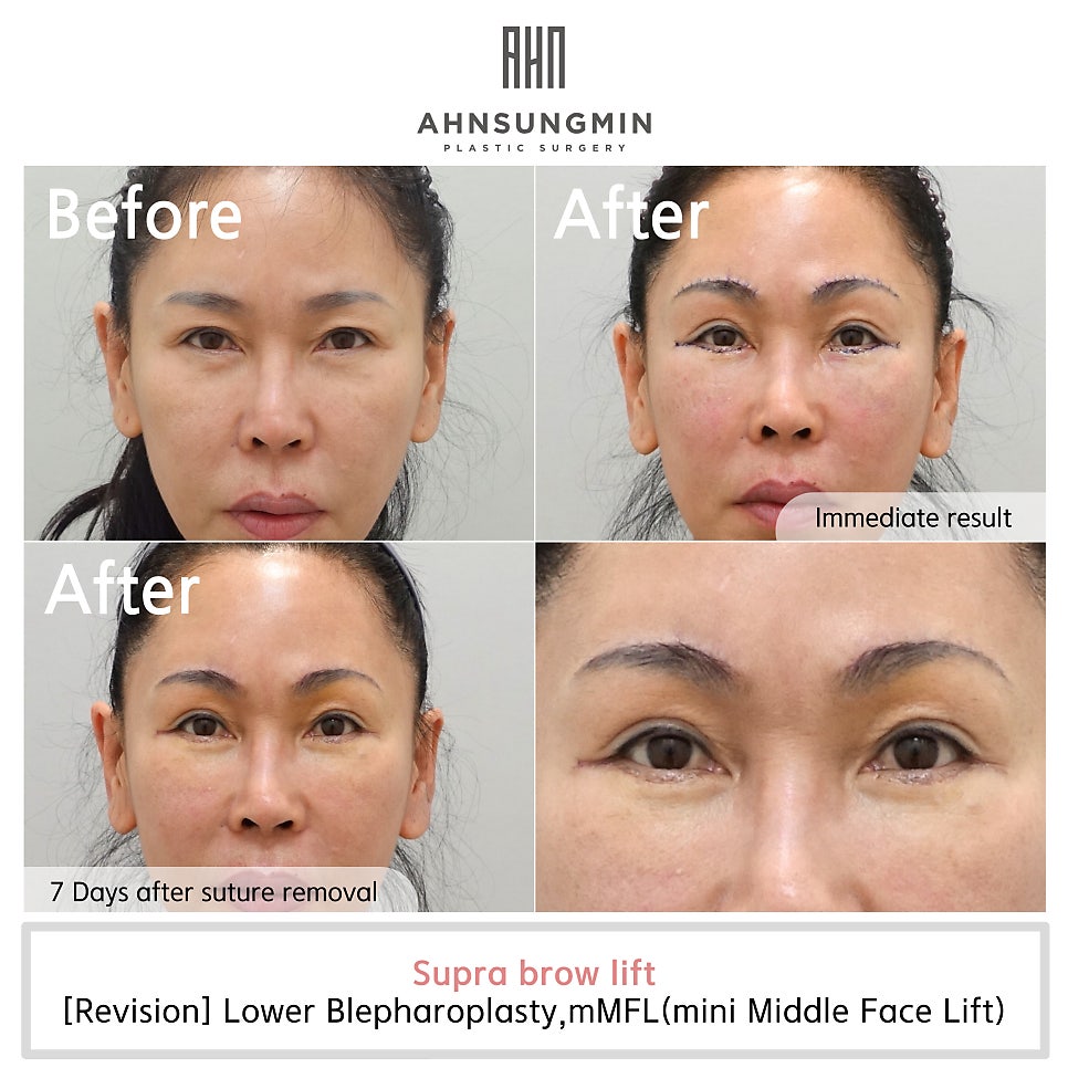 눈썹상거상수술 실밥제거와 흉터 안성민성형외과 관련 이미지 3