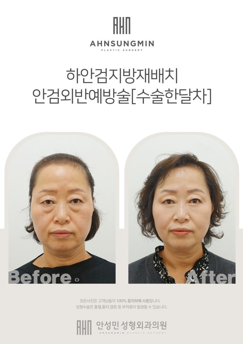 하안검 지방재배치 관련 이미지 2