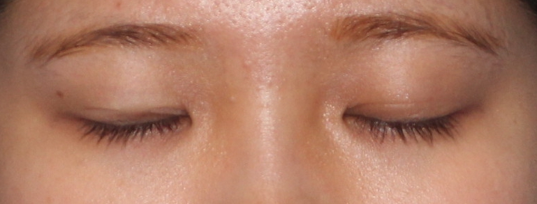 쌍꺼풀 수술과 쌍꺼풀테이프 안성민성형외과 관련 이미지 2