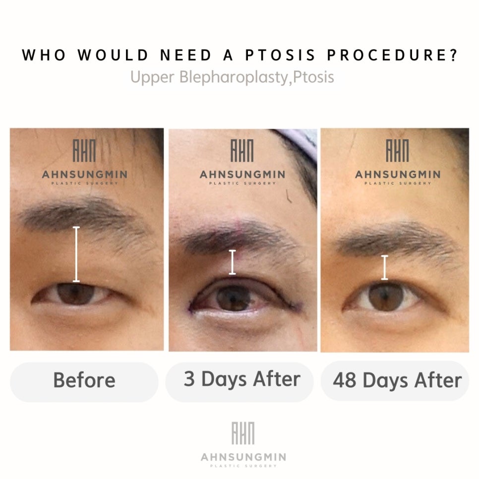 남자 안검하수 눈매교정 눈썹과 눈의 거리가 좁아지는 이유는? 관련 이미지 2