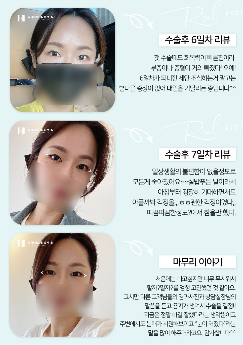 [잠실동성형외과] 듀얼트임 7일차 리얼후기 관련 이미지 4