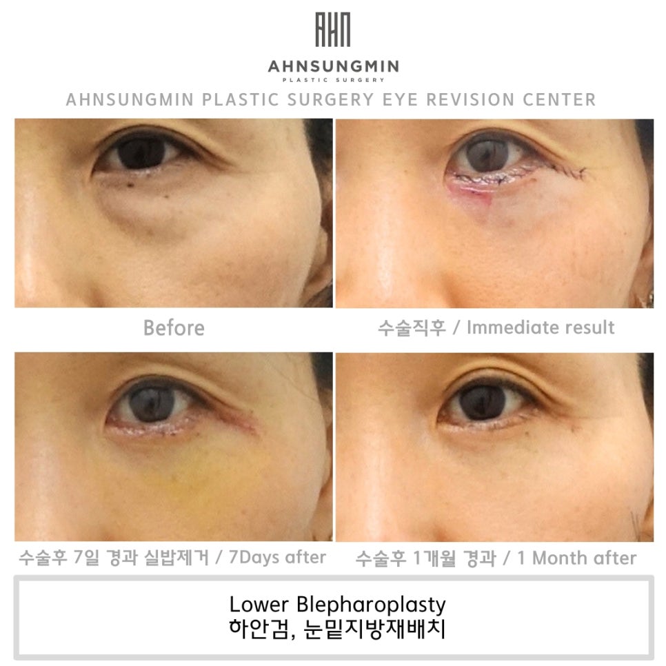 중년 남성의 하안검, 나도 젊어질 수 있을까? 관련 이미지 2