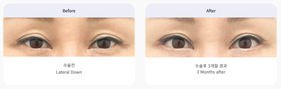 트임 성형의 모든 것 뒤트임, 뒷내림, 밑트임 관련 이미지 1