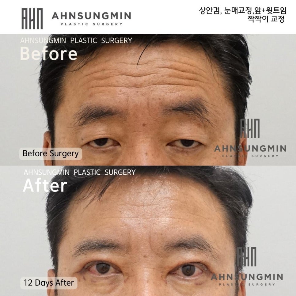 남자안검하수와 트임성형 [ 날카로운눈 온화한 인상으로] 눈이 커지고 싶어요 관련 이미지 2