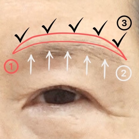 눈썹 거상 수술 흉터와 회복 과정 관련 이미지 4