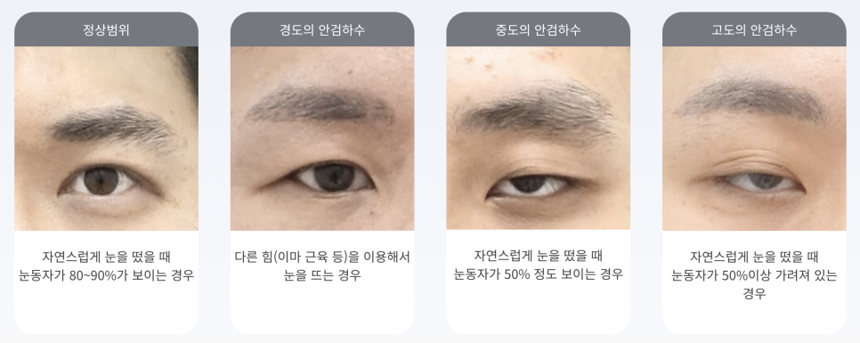 20대 중증 안검하수 수술 후 3개월 경과 관련 이미지 1